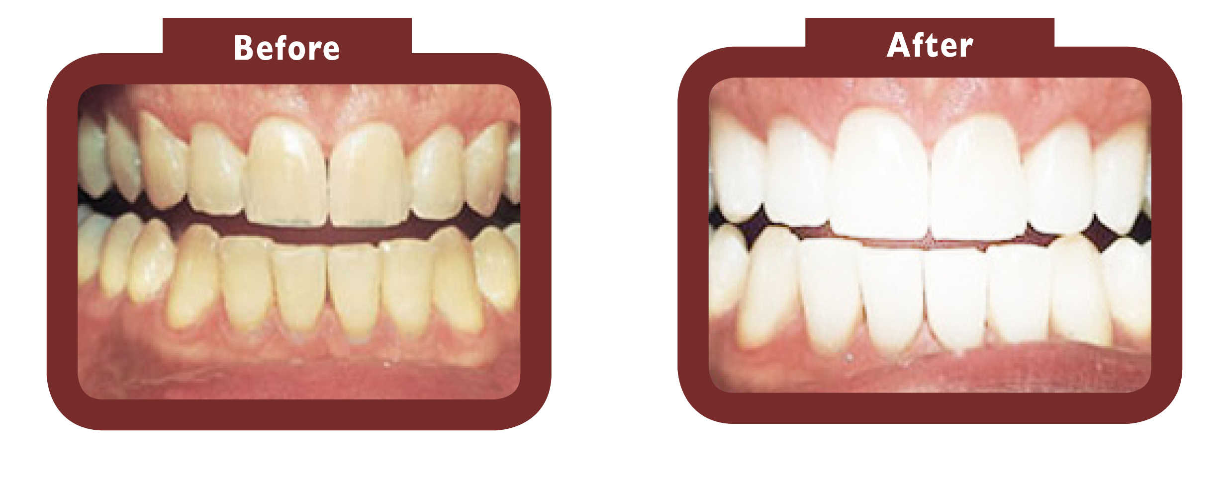 See LA Teeth Whitening before and after results. Contact our team today! Daventry