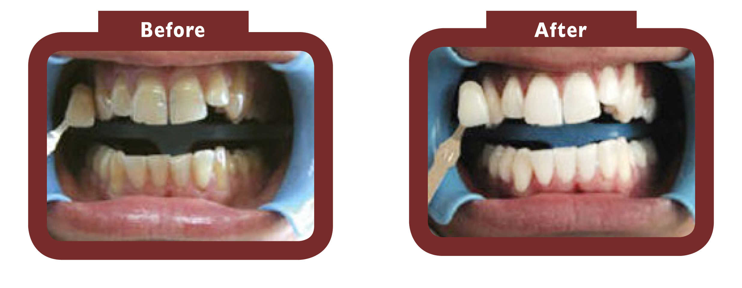 Before and after teeth whitening Daventry - LA TEETH Daventry