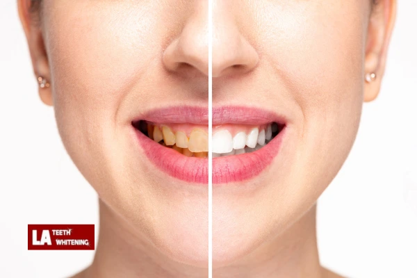 About Us At LA Teeth Whitening Daventry Contact us today! Daventry