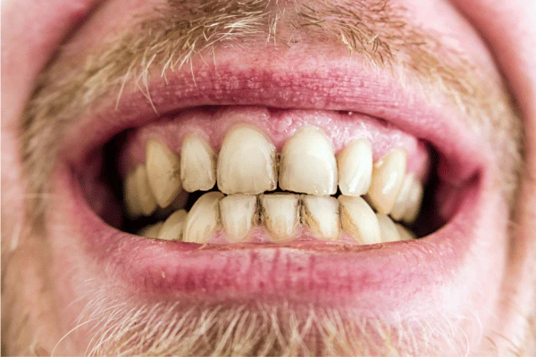 Why Do Lifestyle Habits Like Coffee, Wine, and Smoking Shorten Whitening Results Daventry