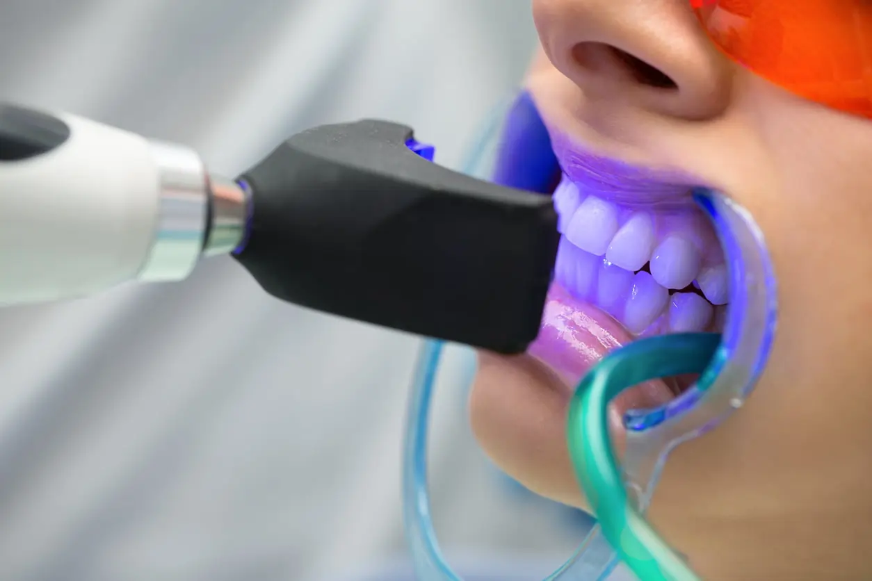 How Does LA Teeth Whitening Combine Safety, Comfort, and Professional Results Daventry