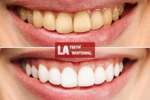 Before and after results - smokers stained teeth results! Daventry