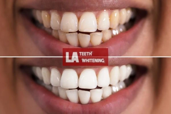 Fast and effective whitening results in one hour. Contact LA Teeth Whitening Daventry to book online Daventry