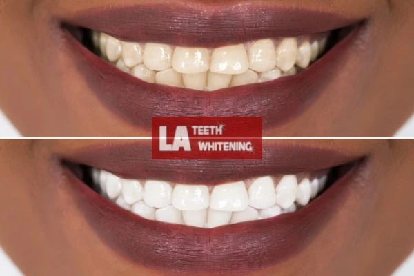 Brighter and white smile - before and after results Daventry book online today! Daventry