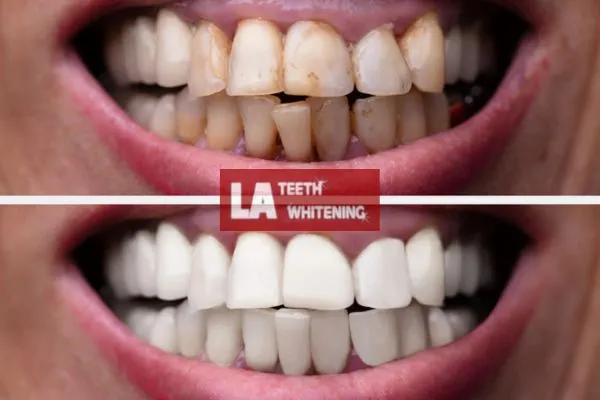 Customer results from LA Teeth Whitening Daventry Book today. Daventry