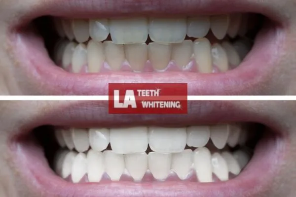 Mens before and after of teeth whitening results Daventry Daventry