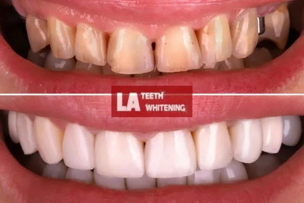 yellow teeth from coffee drinking before and after laser teeth whitening results Daventry