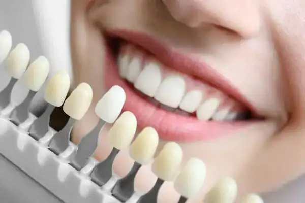 laser whitening Faqs Daventry